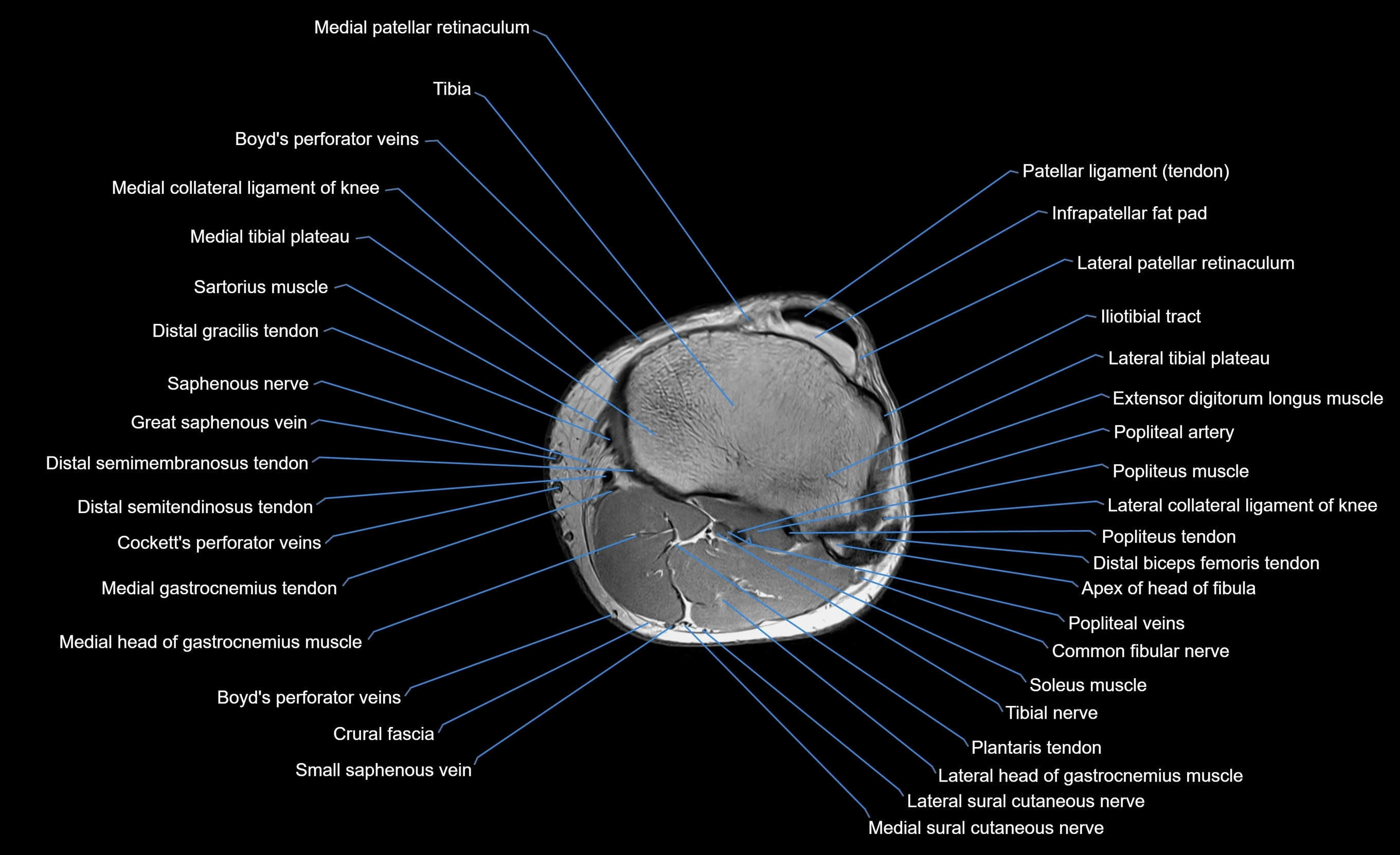 MRI lower leg axial cross sectional anatomy 3T  radiology  image-img-00001-00020.webp